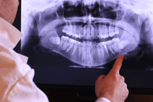 Best Emergency Wisdom Tooth Extraction in Preston, ID
